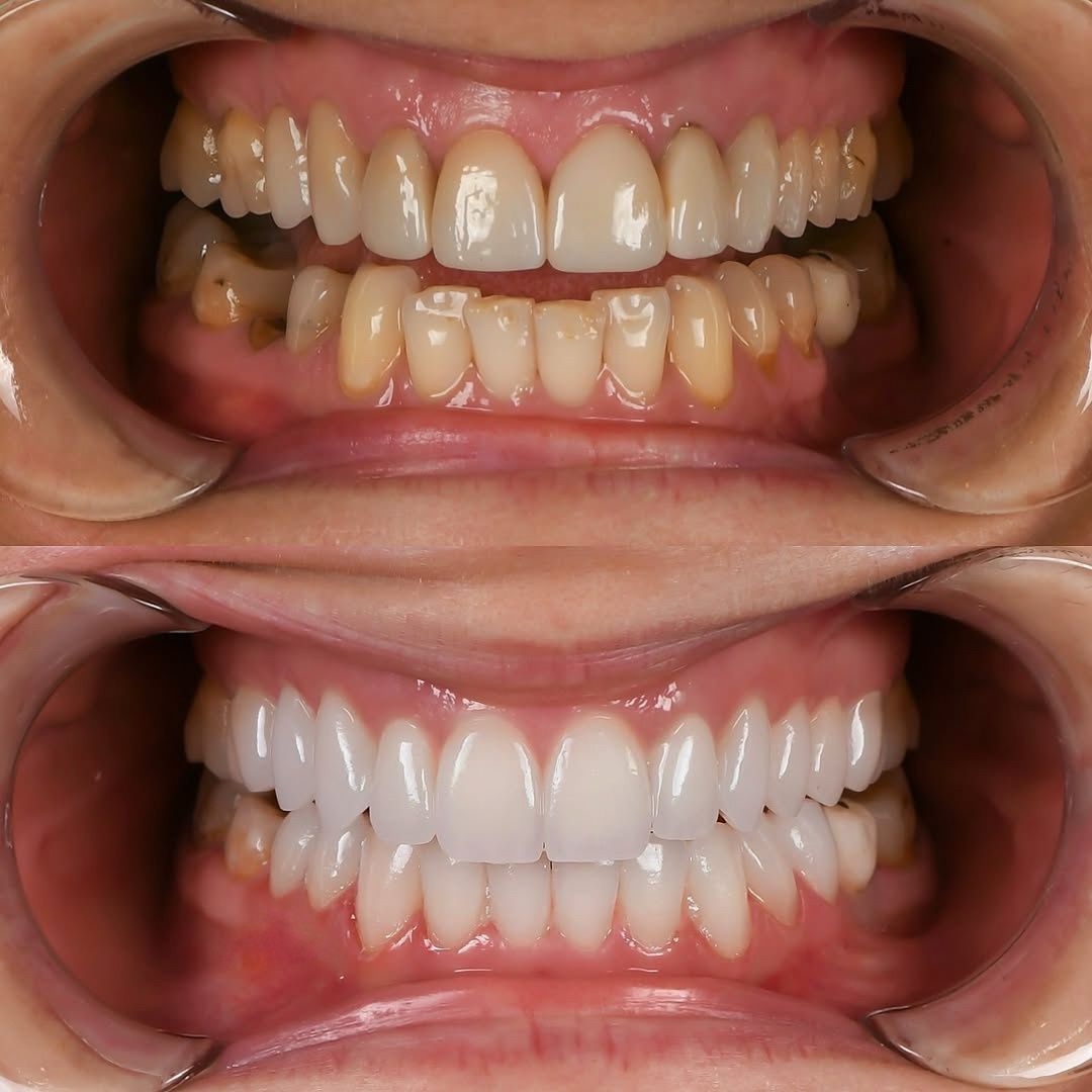 Complete smile makeover showing dramatic before and after transformation